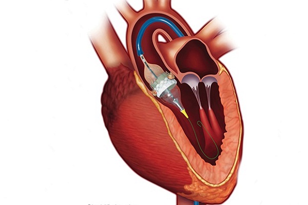 Things you need to know before opting for TAVI/TAVR