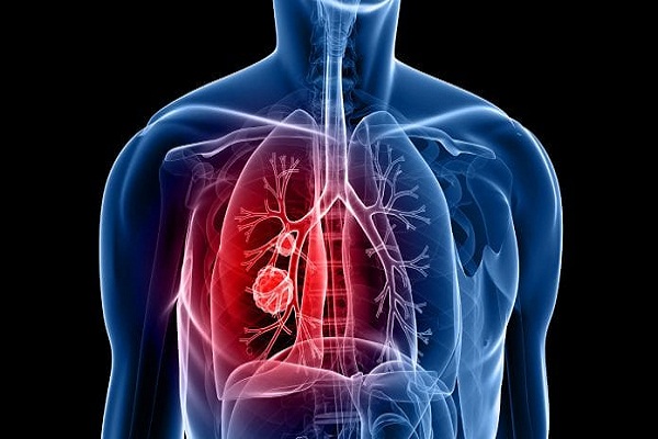 Increased dust, air pollution increasing COPD cases post lockdown