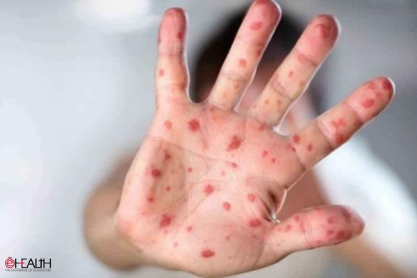 India on high alert against Tomato flu