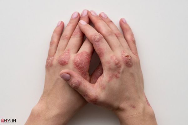 Dupixent® (dupilumab) is now approved in India for the treatment of adults with moderate-to-severe atopic dermatitis